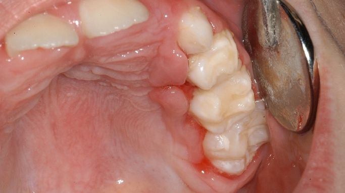 Herpes Labial Al Dente Centre De Sante Dentaire
